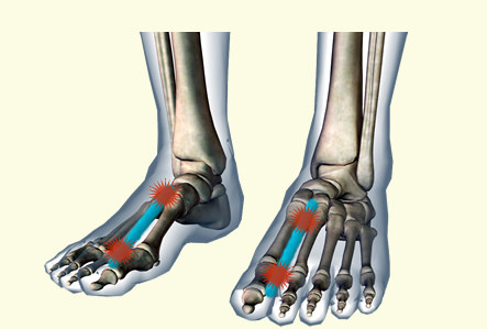 足の甲の痛み 原因 足趾伸筋腱炎