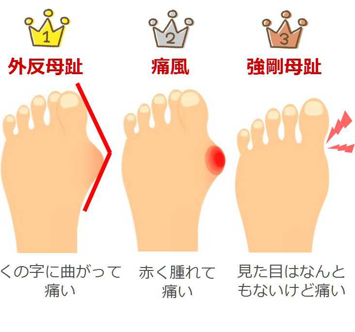 足の親指の付け根が痛い よくある原因 外反母趾 痛風 強剛母趾