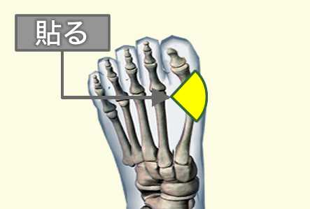 足の親指の付け根が痛い 外反母趾 応急処置 バンドエイド