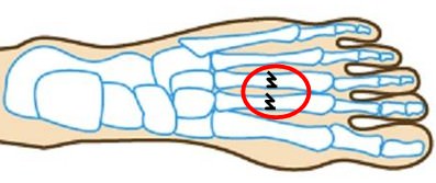 中足骨疲労骨折