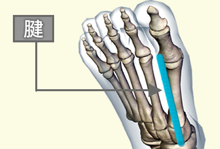 足趾伸筋腱炎