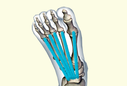 足趾伸筋腱炎