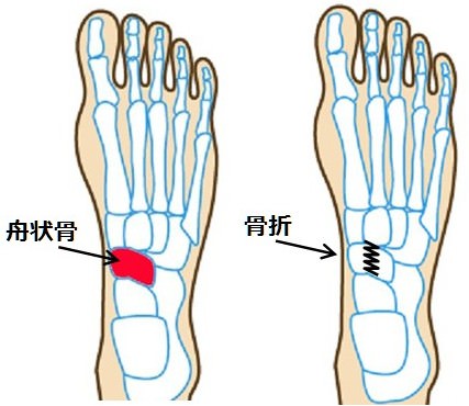 舟状骨疲労骨折