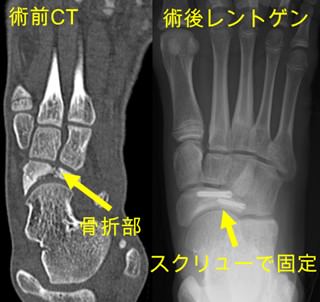 舟状骨疲労骨折