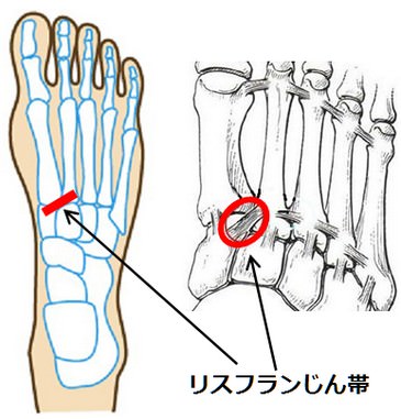 リスフランじん帯損傷