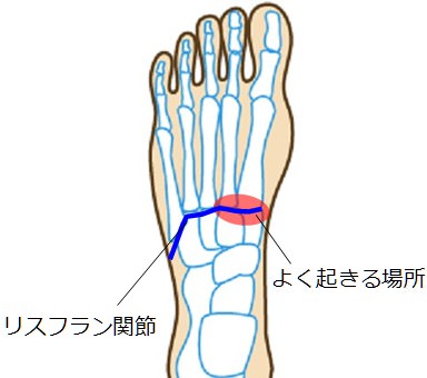 リスフラン関節脱臼・骨折