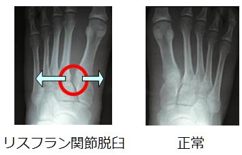 リスフラン関節脱臼・骨折
