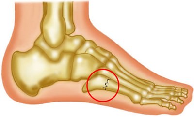 第５中足骨疲労骨折