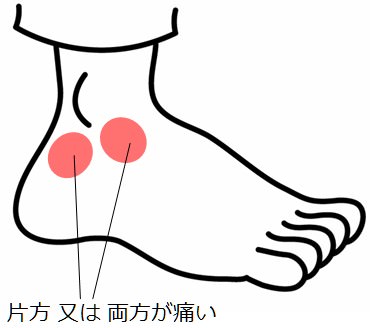 足の甲の痛み 原因 外側じん帯損傷