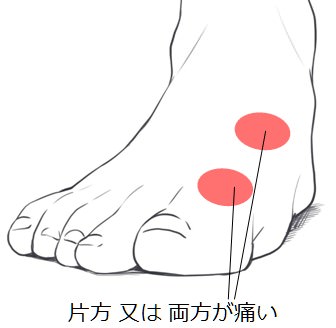 足の甲の痛み 原因 関節リウマチ