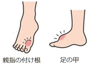 足の甲の痛み 原因 痛風