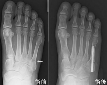 第５中足骨疲労骨折