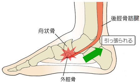 外脛骨障害