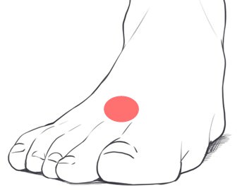 足の甲の痛み 原因 第二ケーラー病