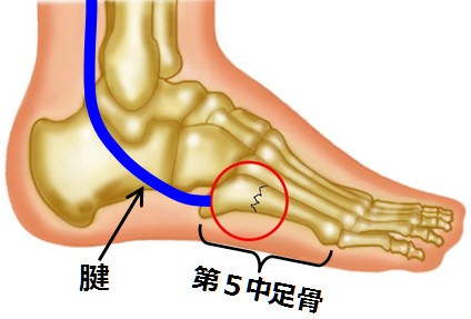 第５中足骨基部骨折 腓骨筋腱捻挫