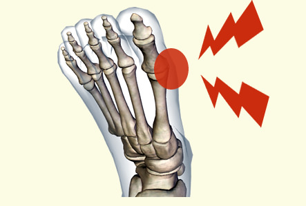 足の親指の付け根が痛い 原因 外反母趾
