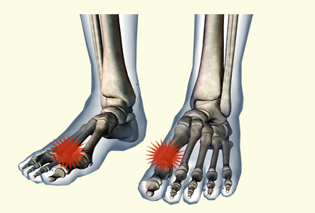 足の親指の付け根が痛い 原因 強剛母趾