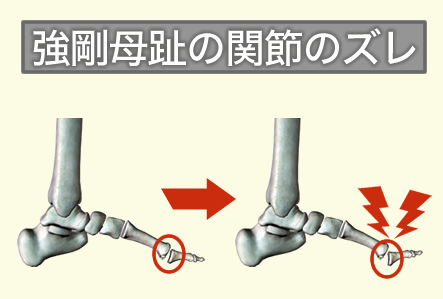 足の親指の付け根が痛い 強剛母趾