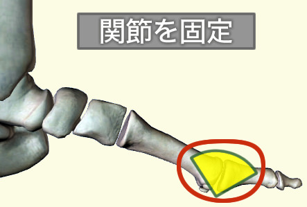 強剛母趾 手術 関節固定