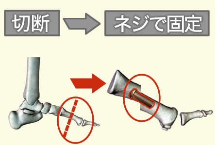 強剛母趾 手術 関節温存