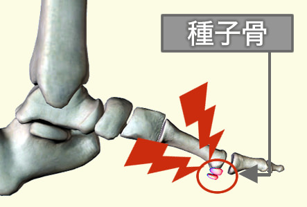 足の親指の付け根が痛い 原因 種子骨炎