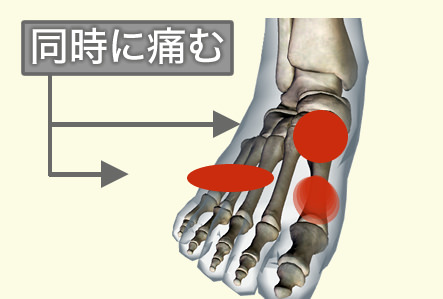 足の親指の付け根が痛い 原因 関節リウマチ