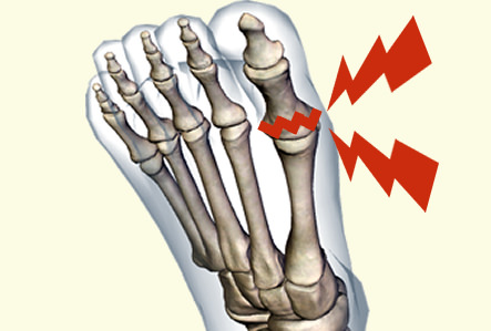足の親指の付け根が痛い 原因 足の親指の疲労骨折