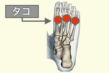 外反母趾の人がタコが出来る場所