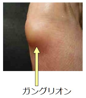 足の親指の付け根が痛い 原因 ガングリオン