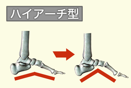 足趾伸筋腱炎 原因 ハイアーチ