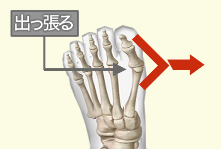 外反母趾の原因 親指の捻れ