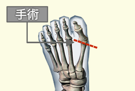 外反母趾 手術