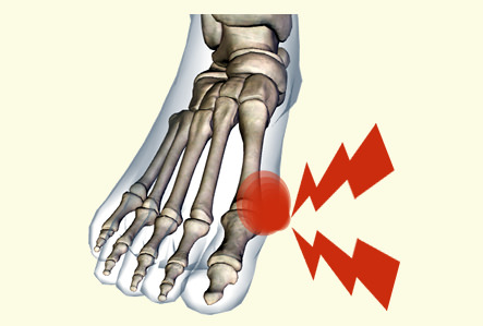 足の親指の付け根が痛い 原因 痛風
