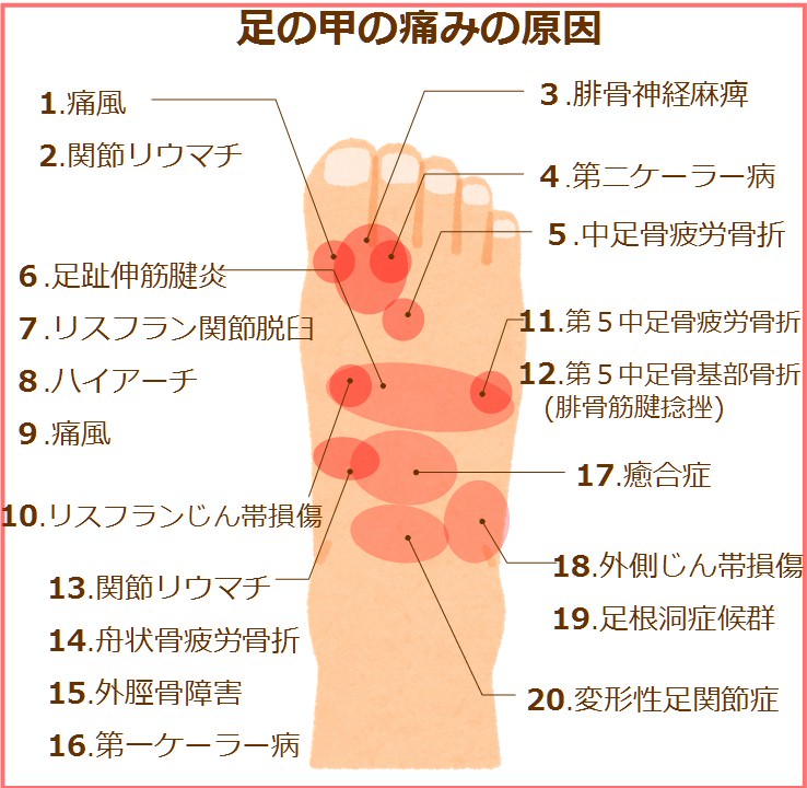 足の甲が痛い 痛む場所ごとに図で見るの原因 趣味なび