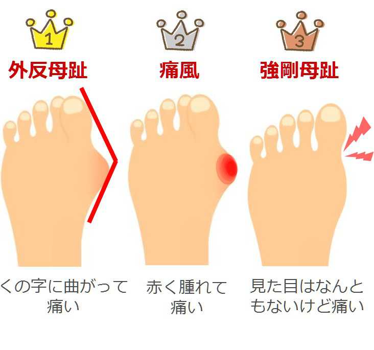 足の親指の付け根が痛い！症状ごとに図で見る11の原因 趣味なび Part 2